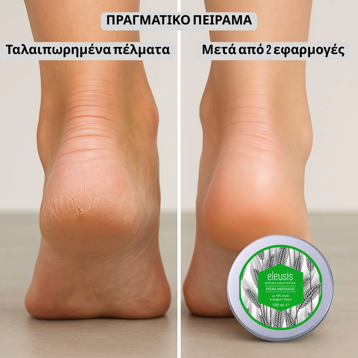 Μια φτέρνα χωρίς εφαρμογή της Regenerating cream και μια φτέρνα μετά από 2 εφαρμογές