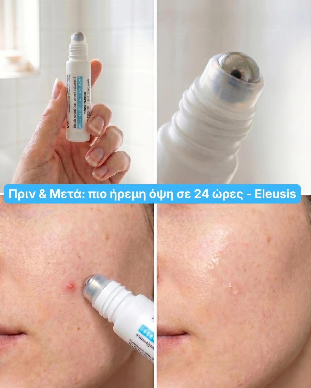 Πριν και μετά σπυράκι μετά την εφαρμογή anti spot roll on Eleusis Cosmetics
