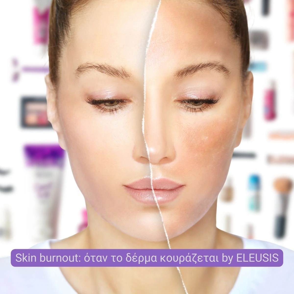 Skin burnout – όταν το skincare δεν δουλεύει και ο επιδερμικός φραγμός κουράζεται